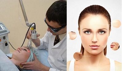 Si kryhet përtëritja e lëkurës me laser